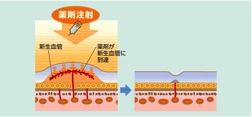 抗ＶＥＧＦ療法とは