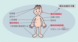 糖尿病網膜症とは