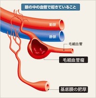 糖尿病網膜症とは