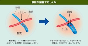 網膜静脈閉塞症とは