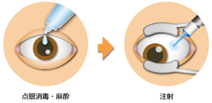 ルセンティス療法とは