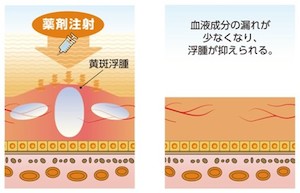 抗ＶＥＧＦ療法とは