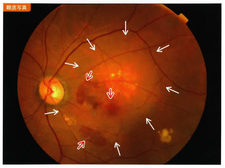 加齢黄斑変性_眼底写真