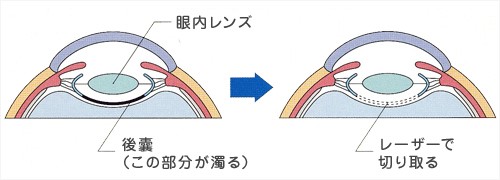 後発白内障