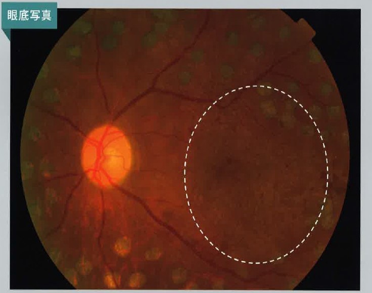 糖尿病網膜症眼底写真
